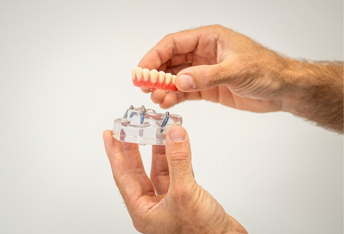 All-on-4 Implantate